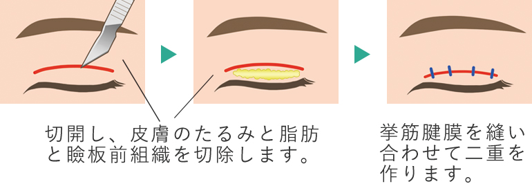 二重切開法