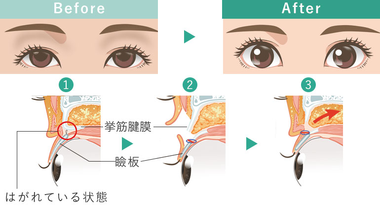 眼瞼下垂