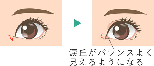 目頭切開