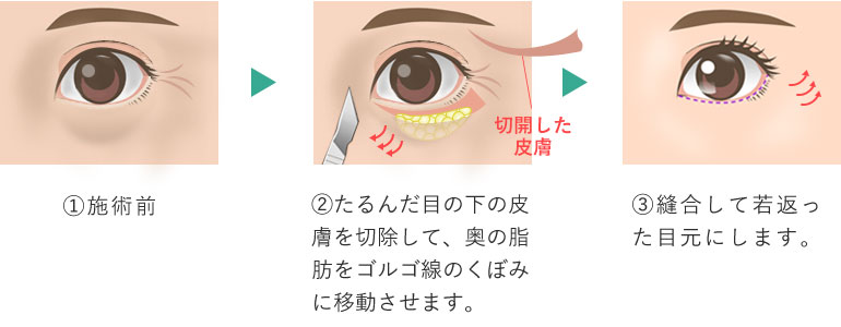 下眼瞼たるみ取り(ハムラ法)
