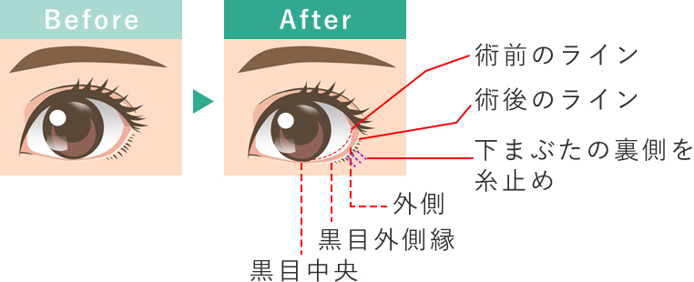 切らないグラマラスライン形成