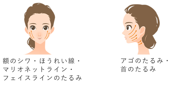 ロイヤルリフト(糸リフト)