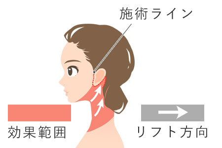 ネックリフト