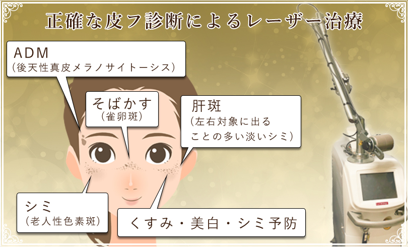 シミ取りレーザー