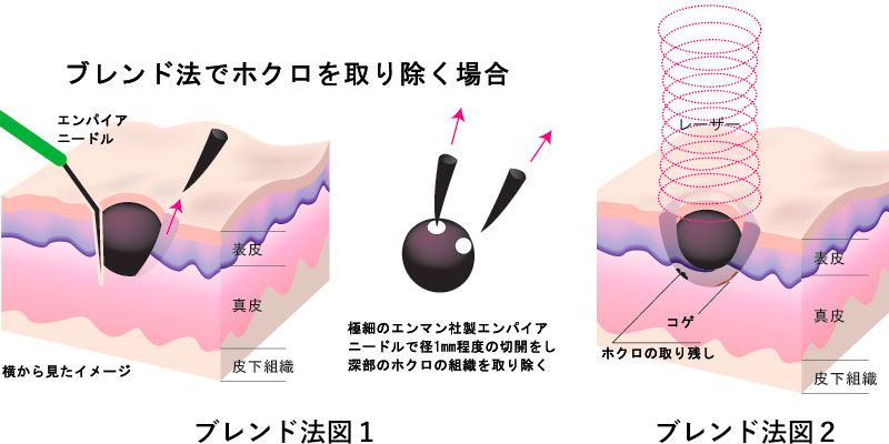 ほくろ除去 眼形成 リフトアップ Aga治療なら東京ロイヤルクリニック