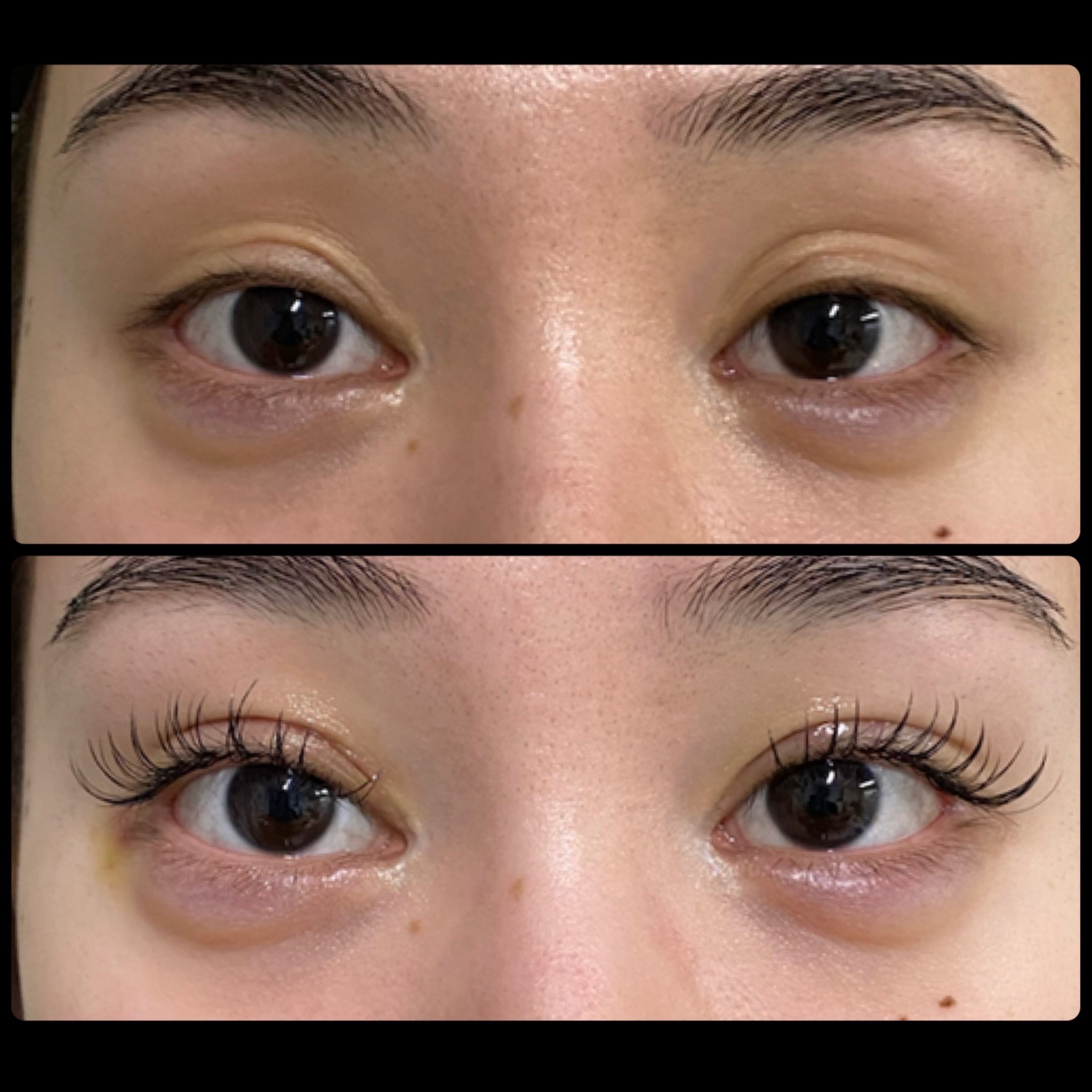 眼瞼下垂手術の症例：開きを良くして美しい二重を形成！ - 眼形成