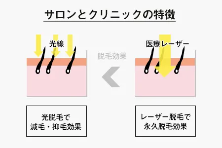 医療脱毛とサロン脱毛の違い｜クリニックは1回あたりの効果が高く、サロンは痛みが少ない